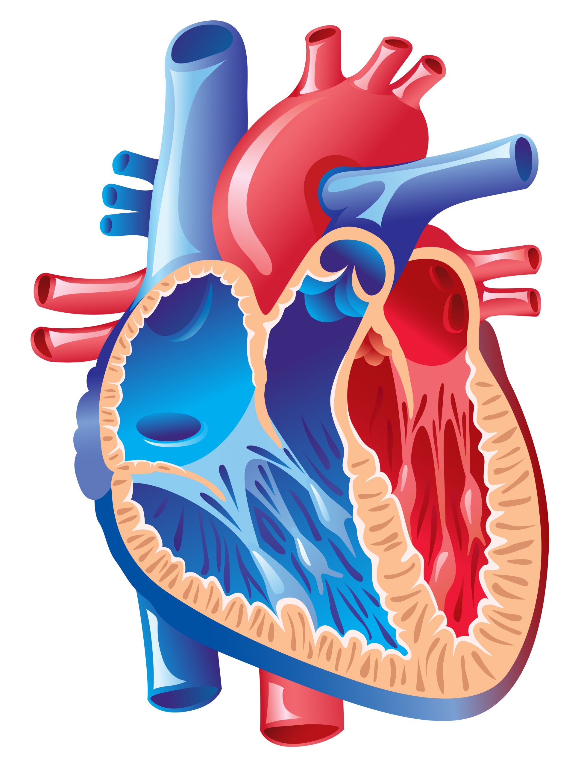 Arrhythmogenic Right Ventricular Dysplasia