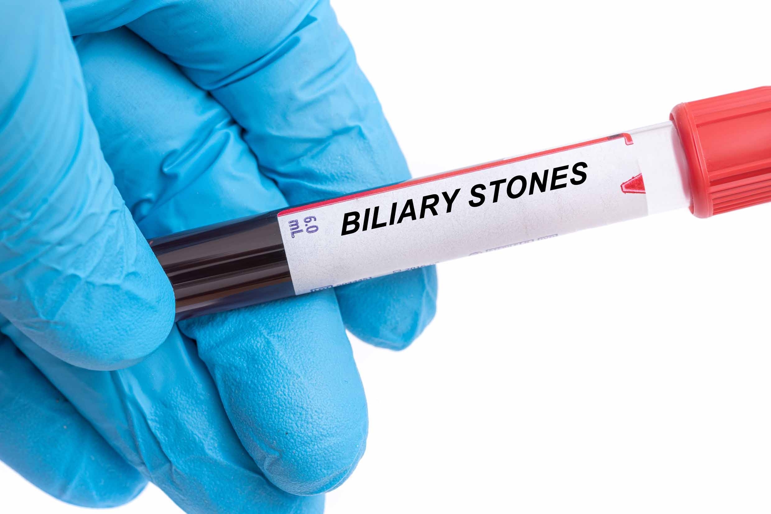 Biliary Stones