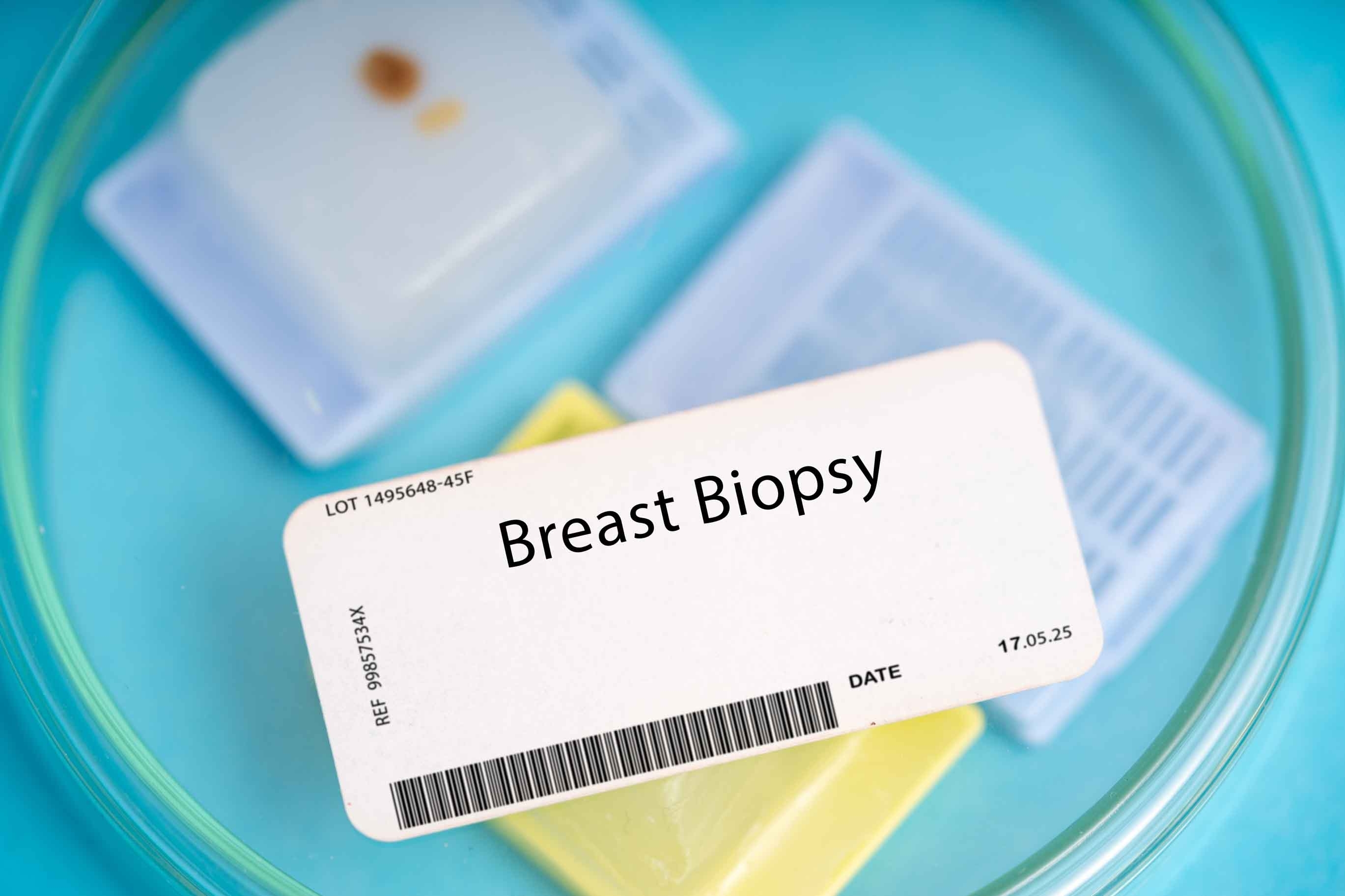 Breast Biopsy: Accurate Diagnosis & Treatment