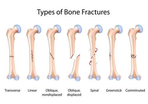 Transverse Fracture: Types, Symptoms, Causes, Risk & Treatment