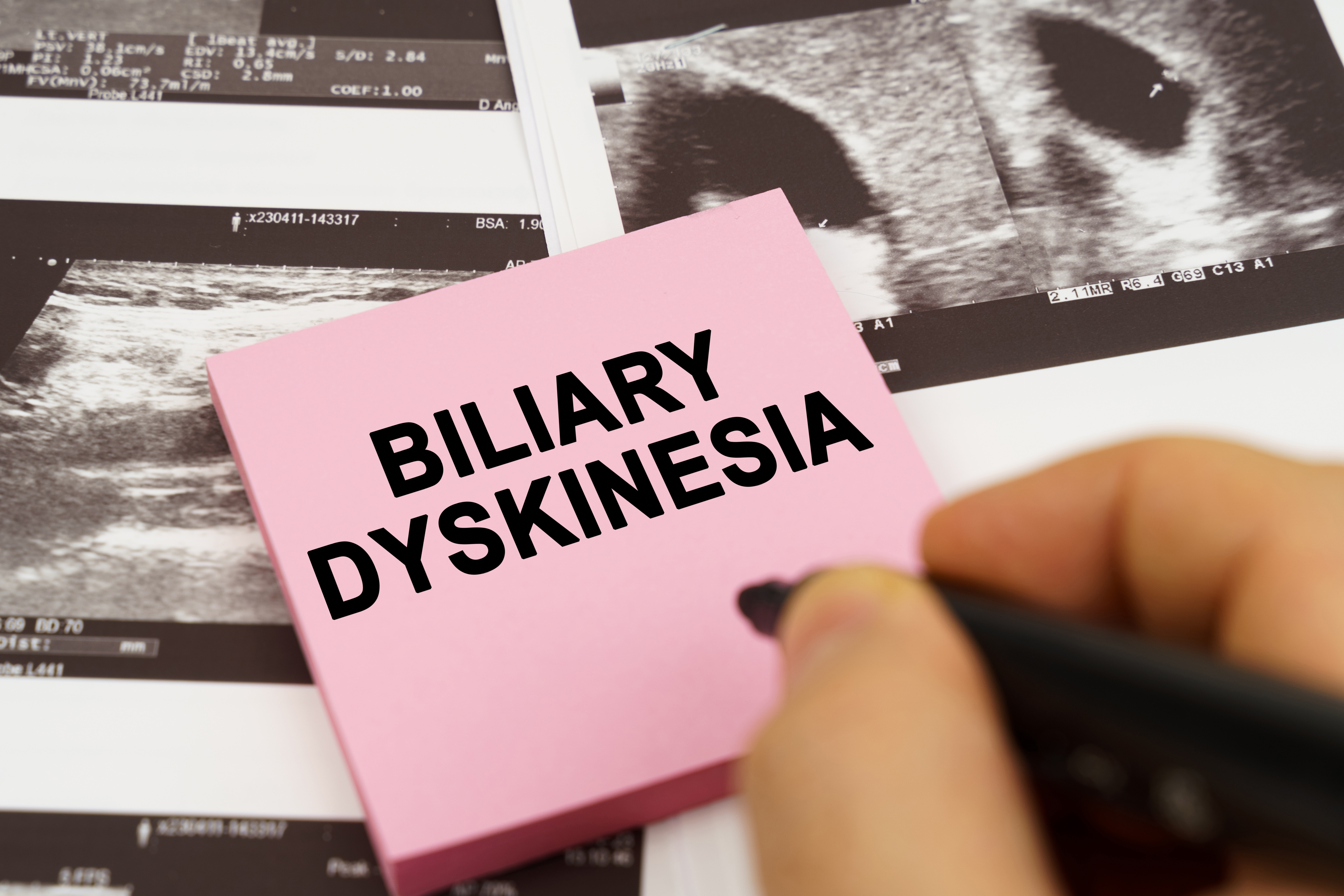 Understanding Biliary Dyskinesia