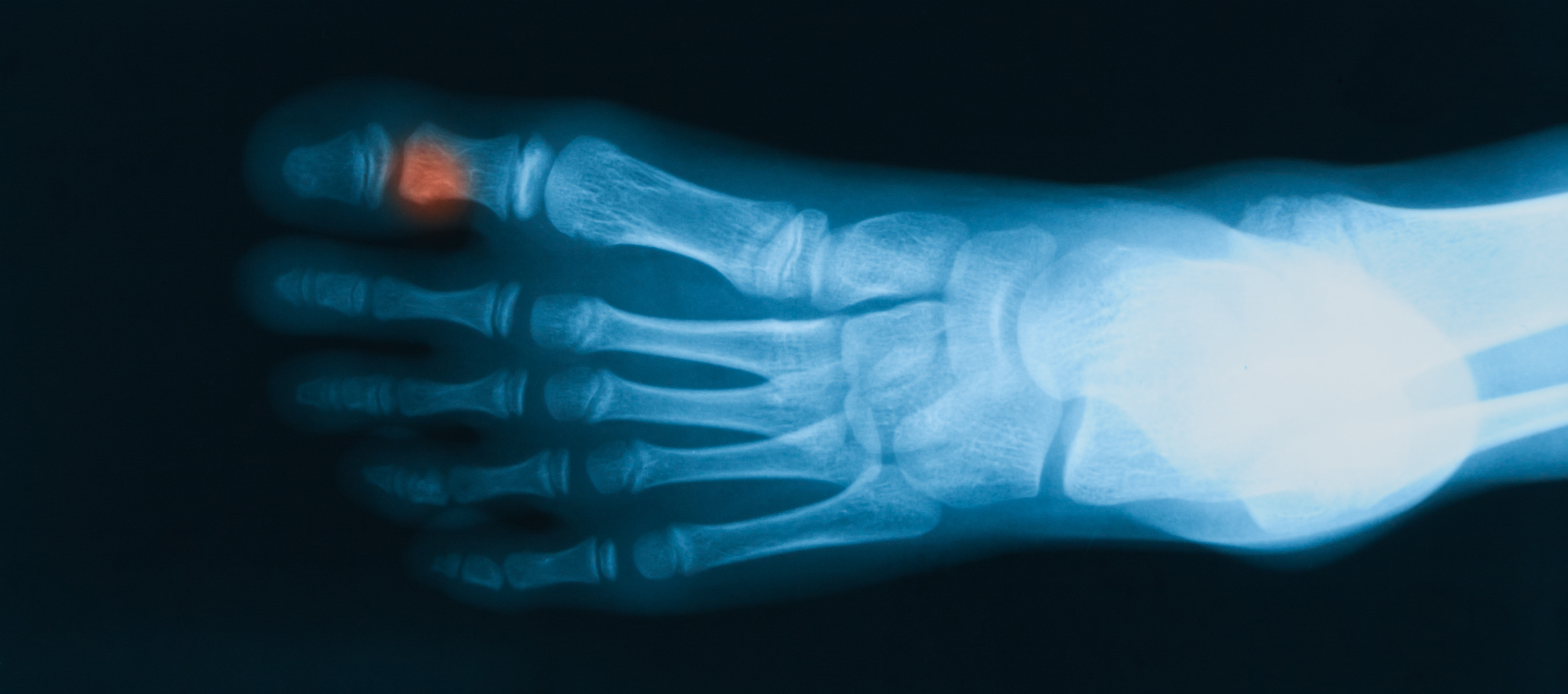 Sesamoid Bone Fractures: Symptoms, Causes, Recovery & Treatment