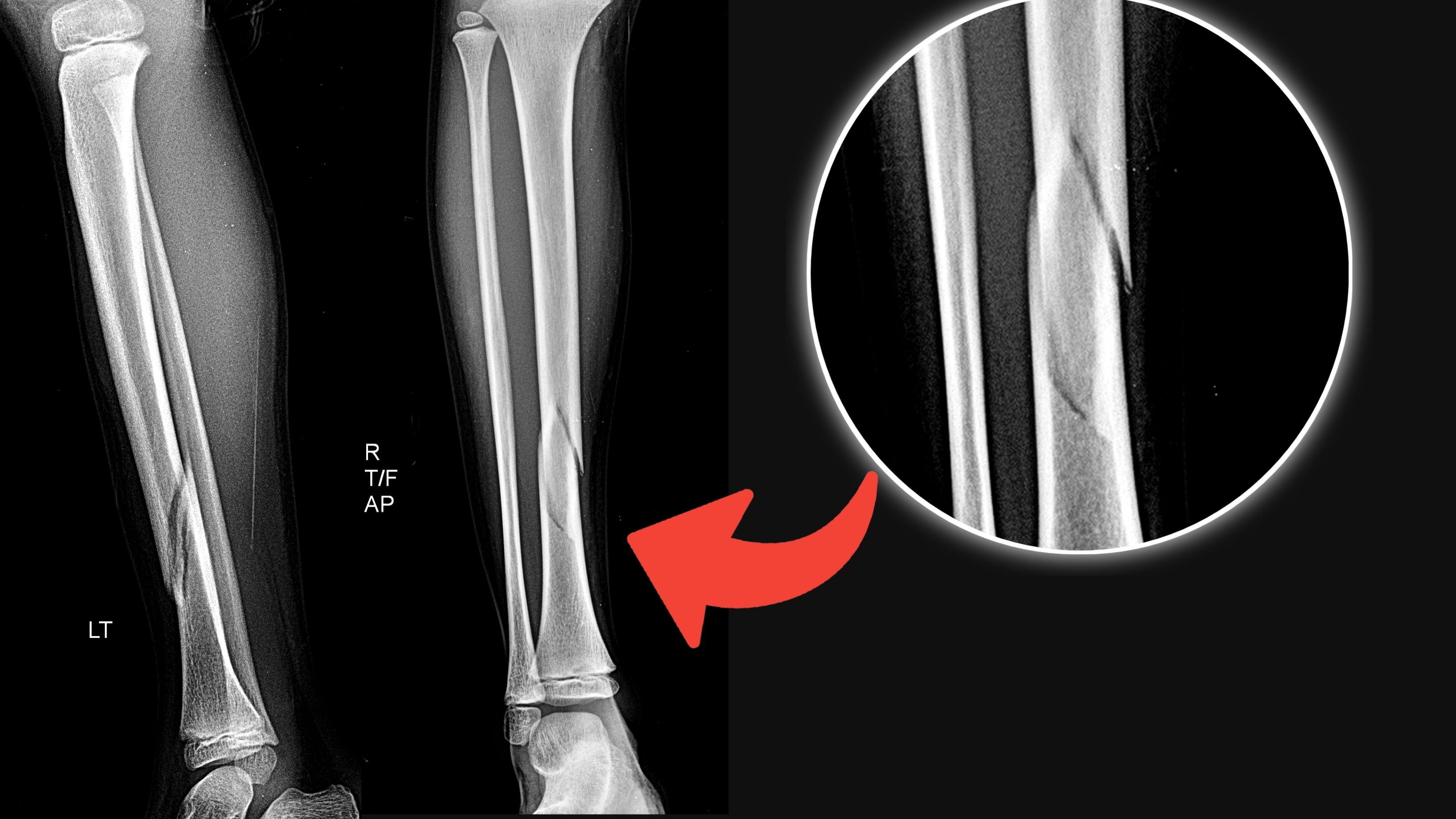 Spiral Fracture: Symptoms, Causes, Diagnosis & Treatment