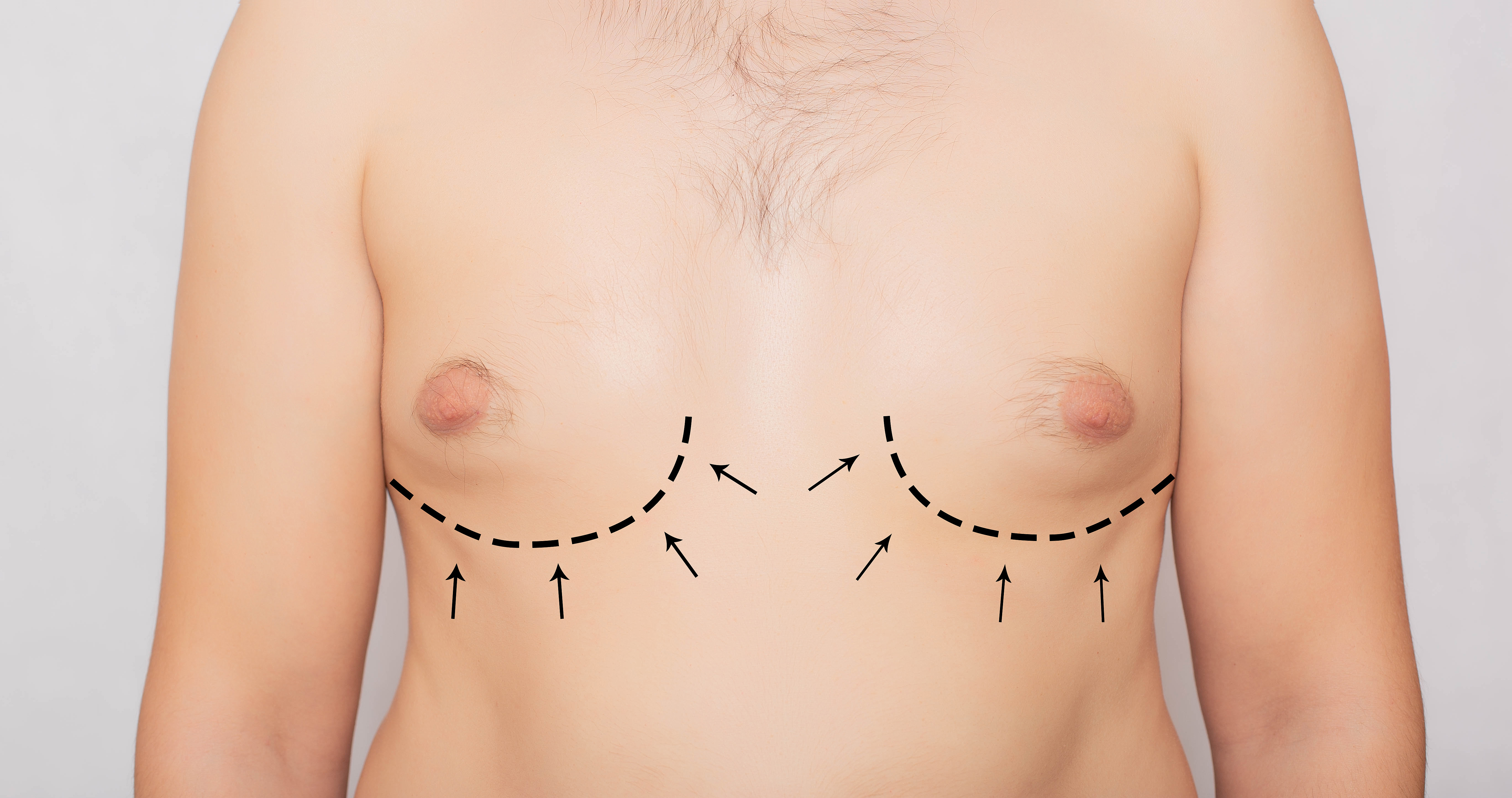 Breast Reduction Surgery