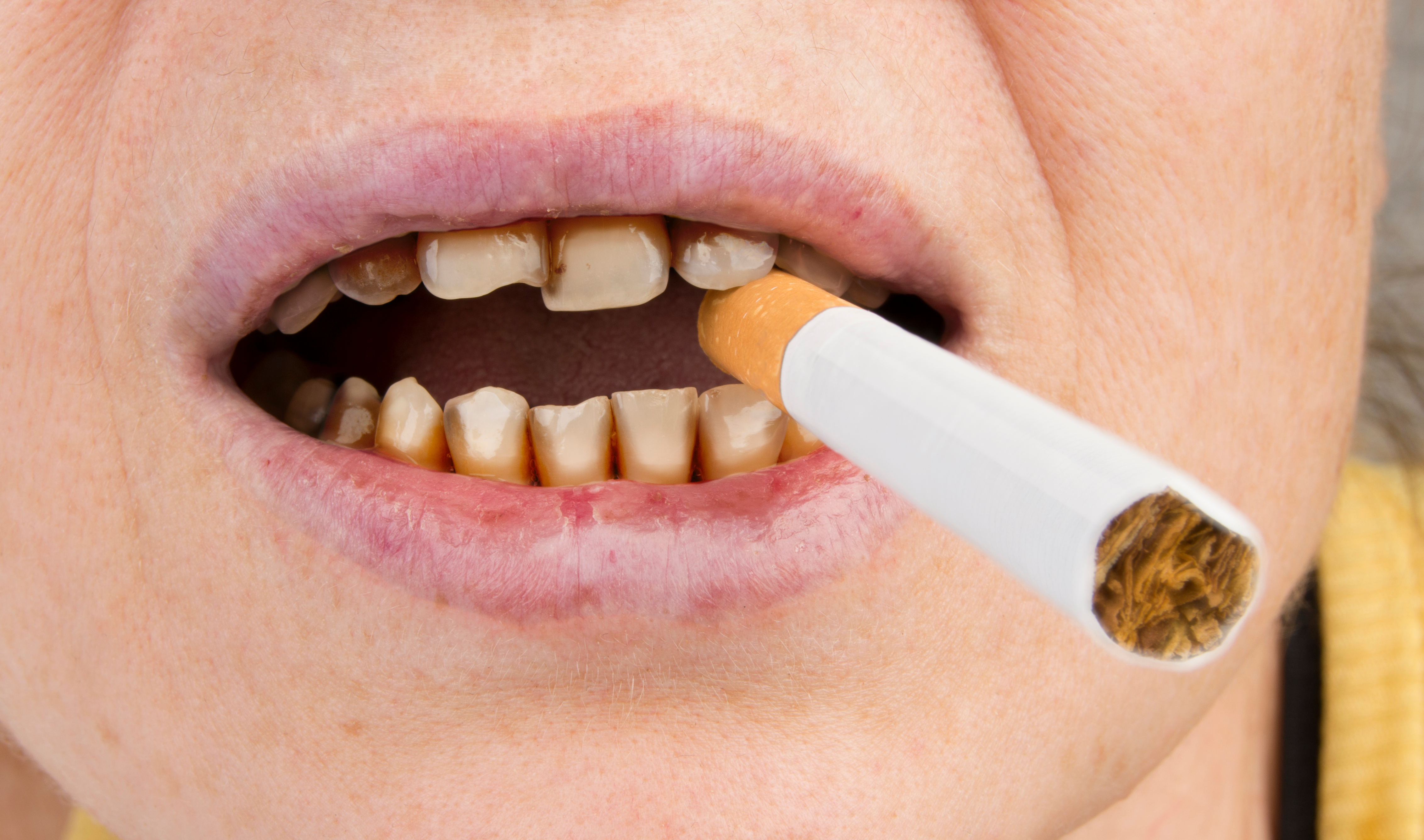 Mouth Ulcers and Smoking