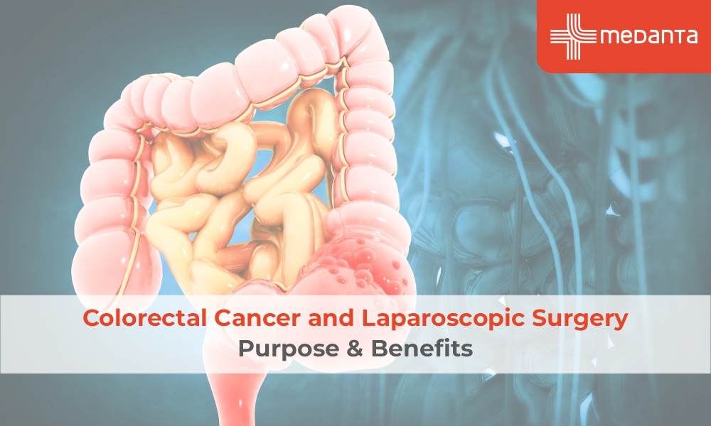 Colorectal Cancer and Laparoscopic Surgery: Purpose & Benefits