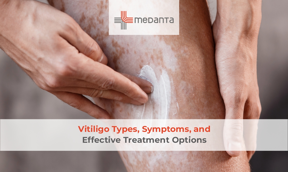 Vitiligo Types, Symptoms, and Effective Treatment Options