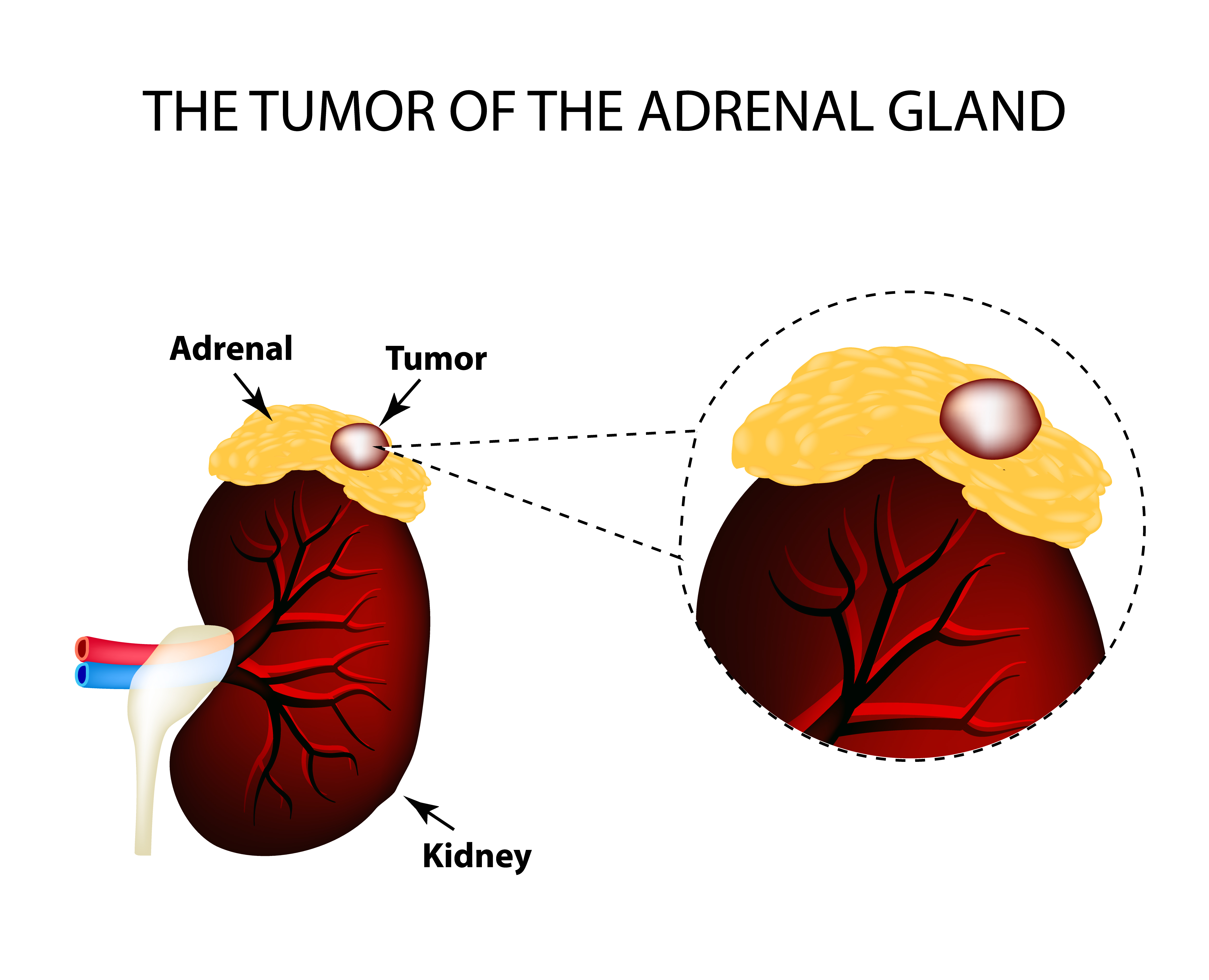 Adrenal Gland Tumors