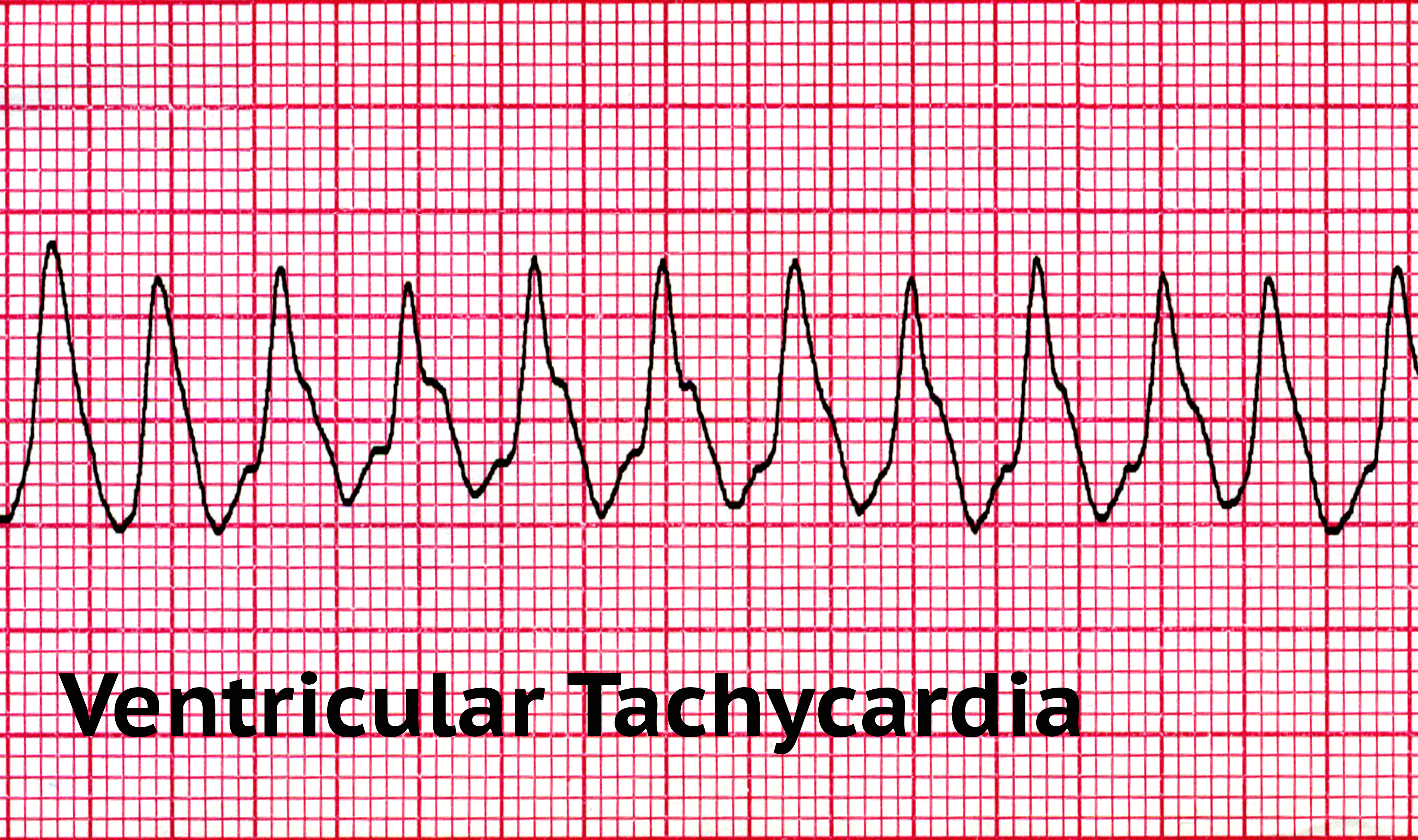 Know more about Ventricular Tachycardia