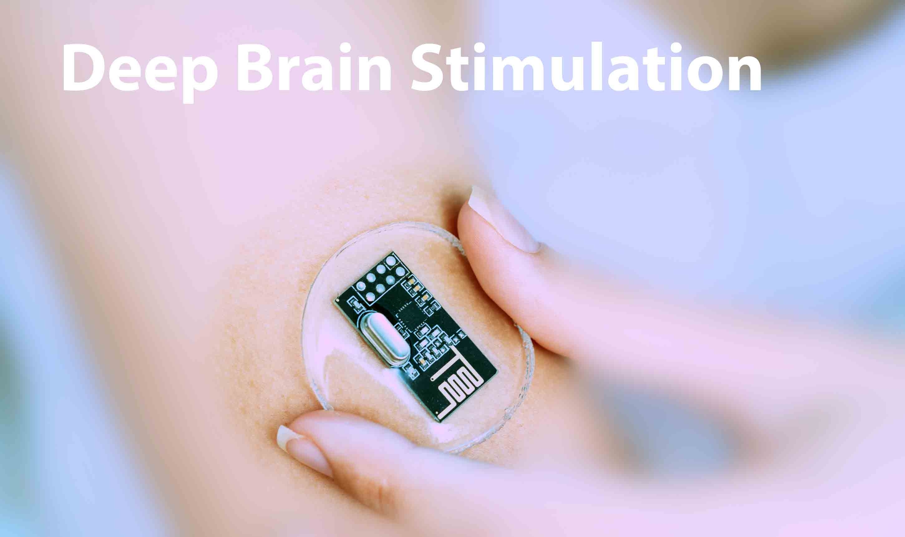 Deep Brain Stimulation