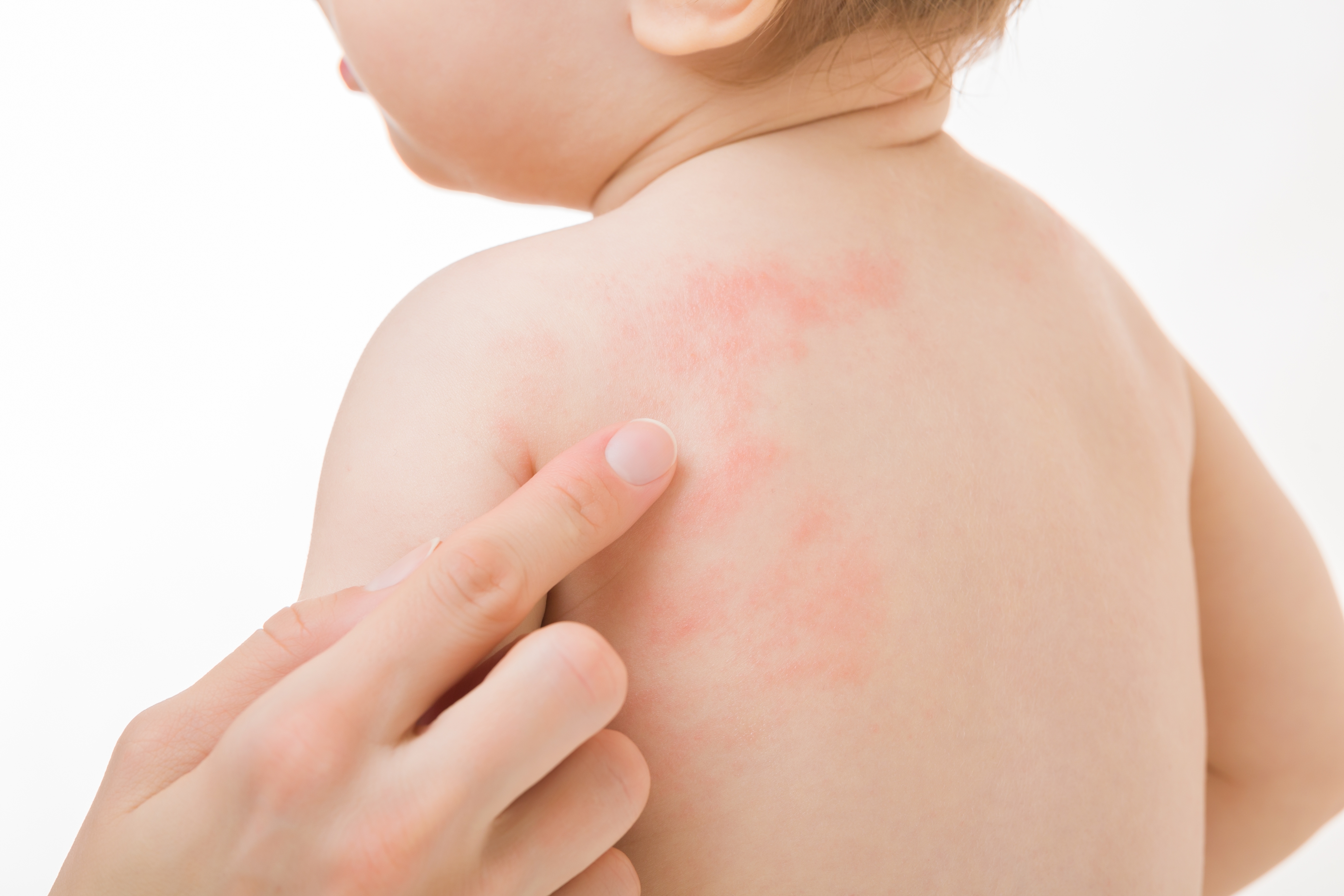 Common Childhood Rashes