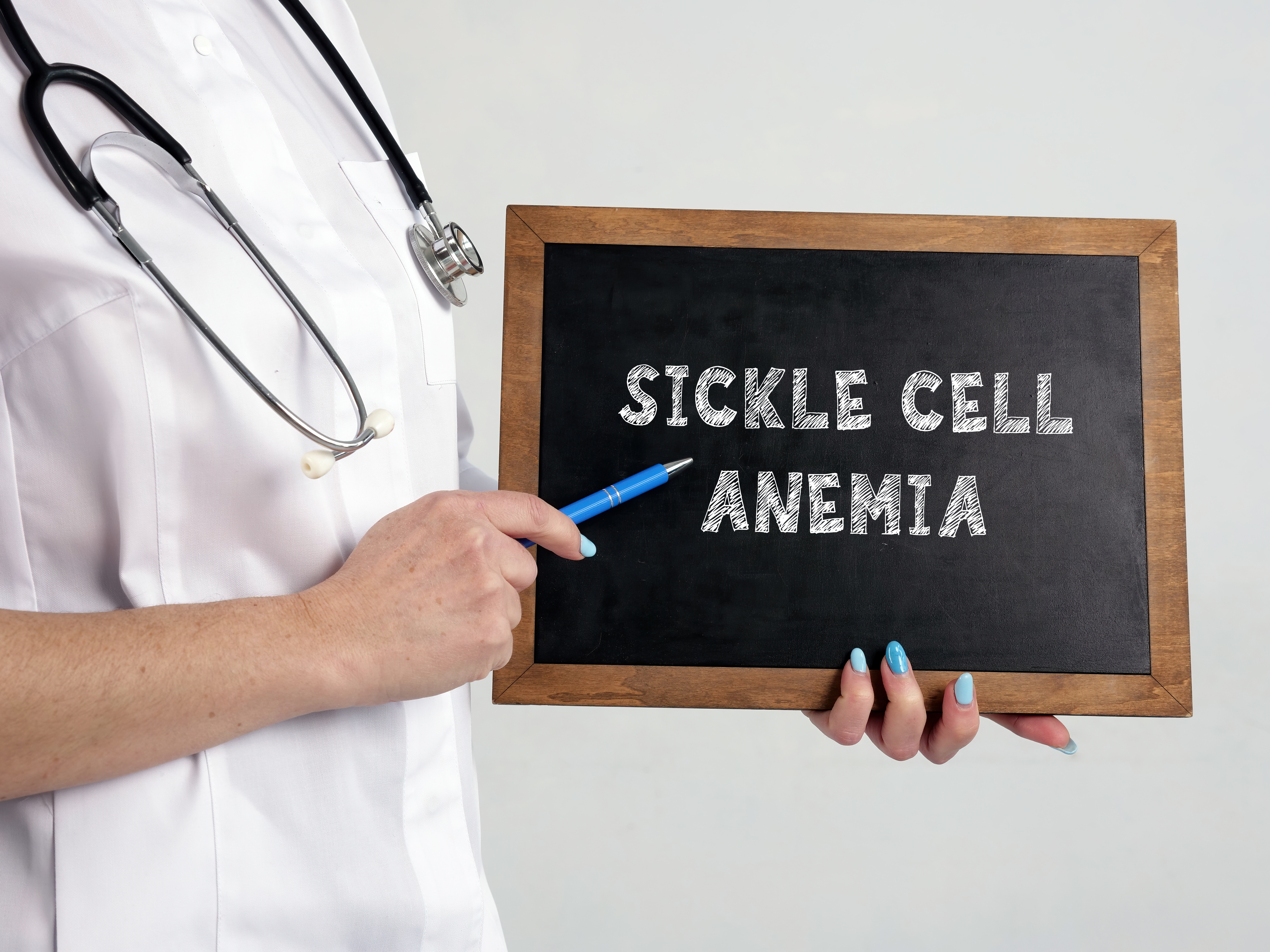 Sickle Cell Anemia