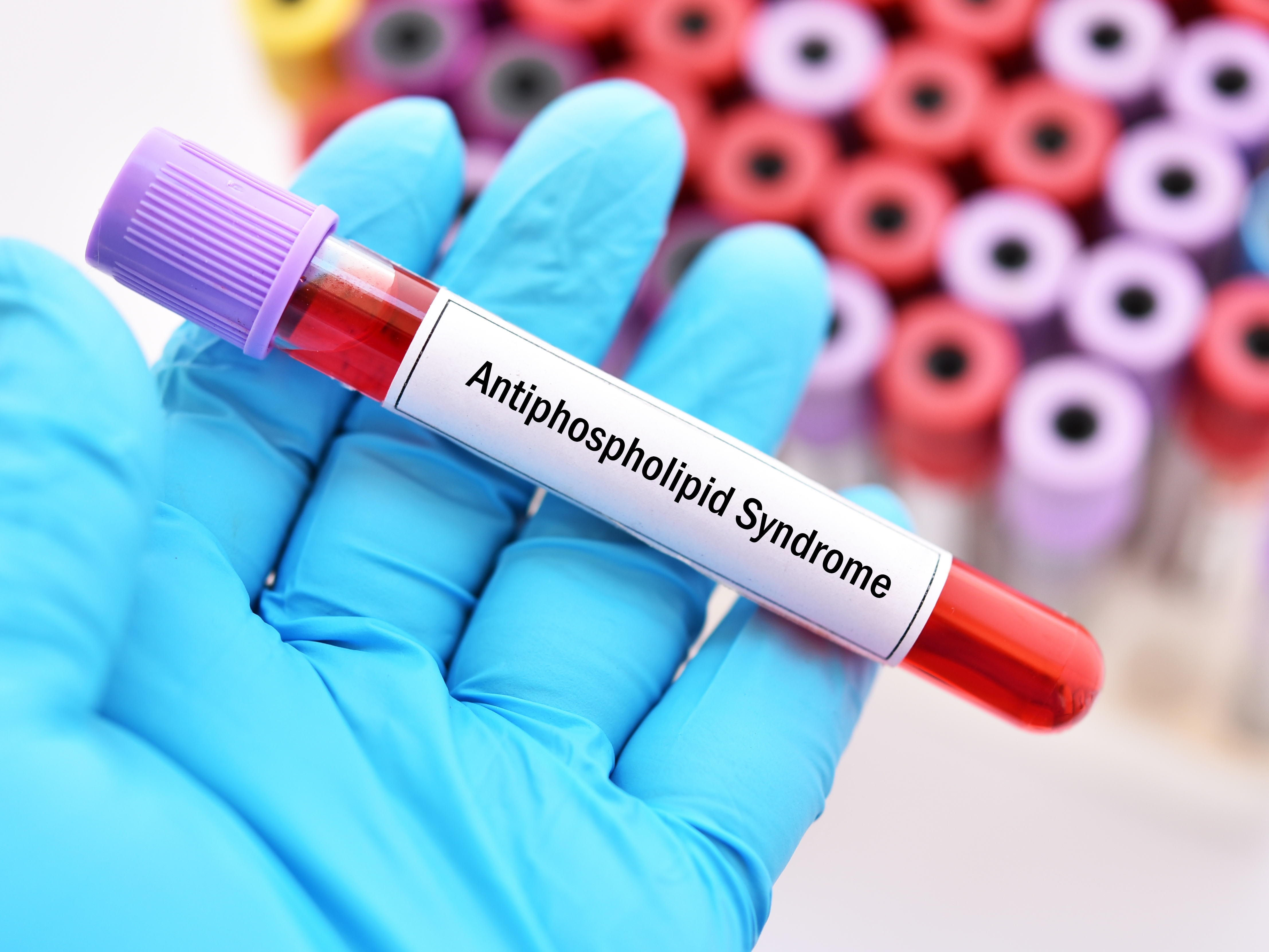 Antiphospholipid Syndrome