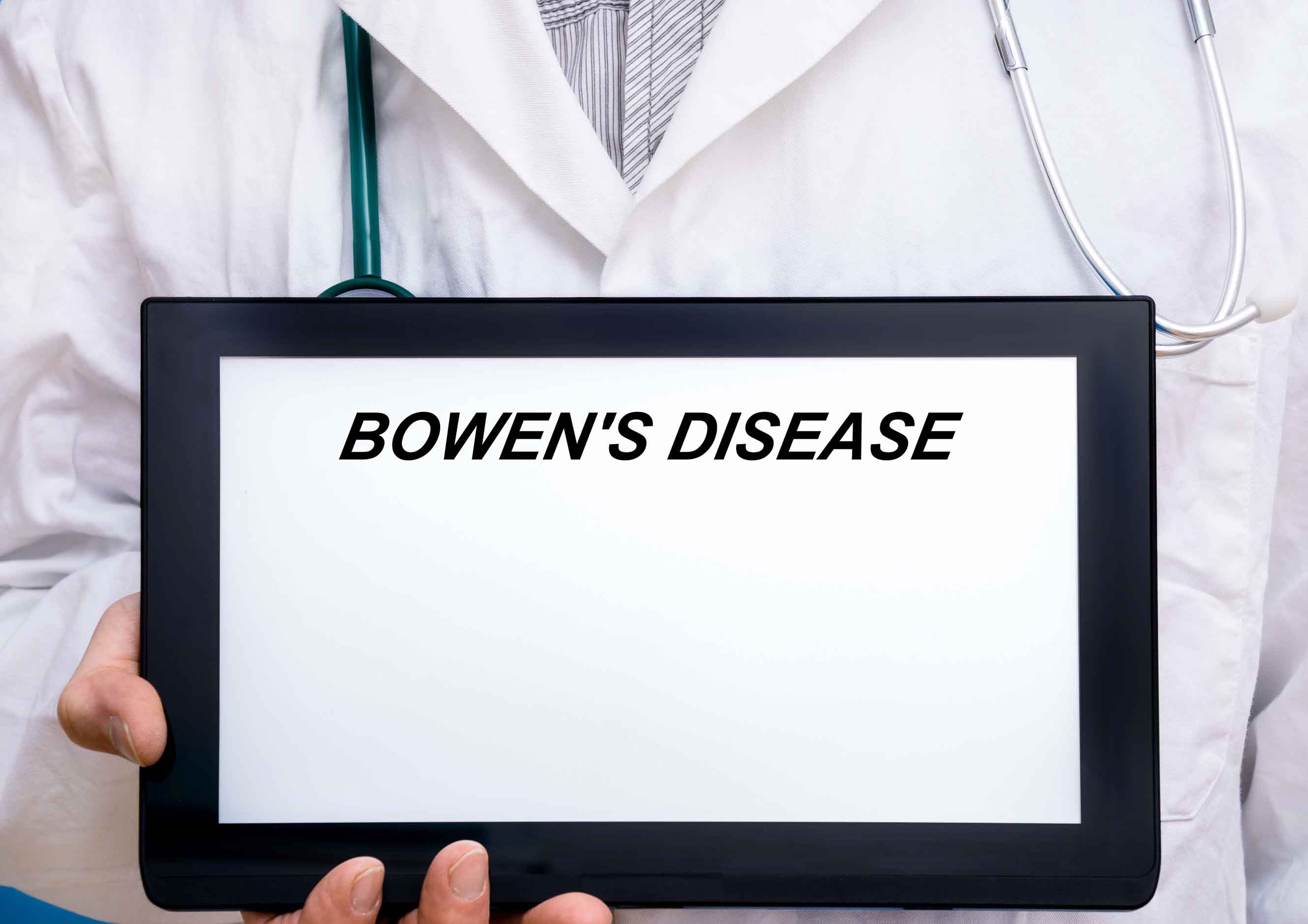 Bowen’s Disease