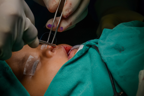 Cleft Lip or Cleft Palate Surgery