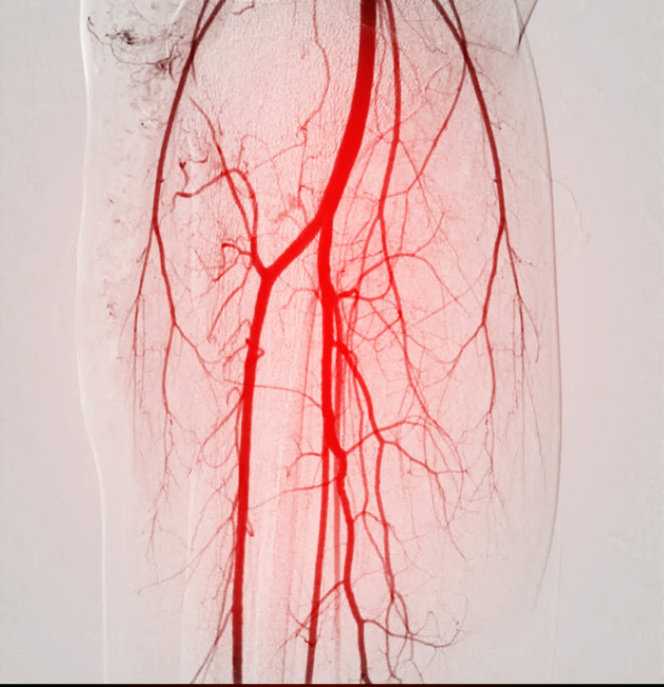 Peripheral Arterial Disease 