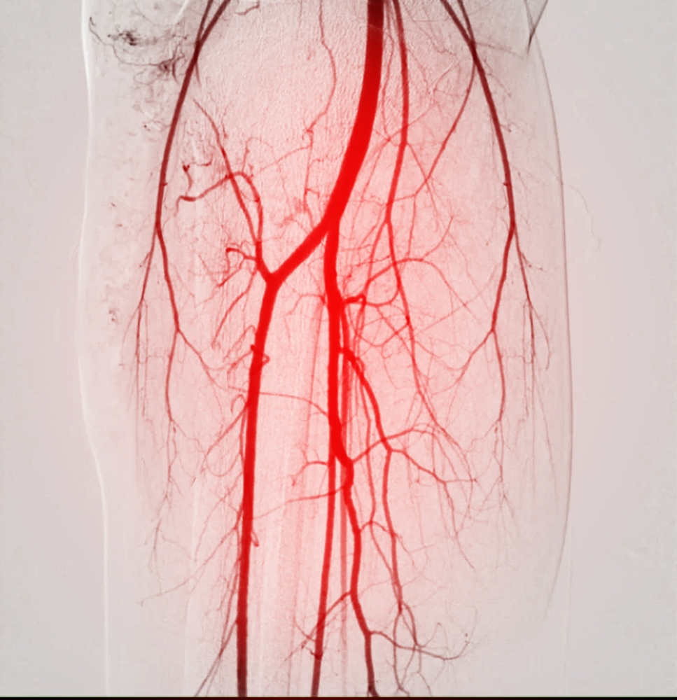 Embolisation for vascular malformations