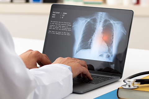 Carcinoma Lung