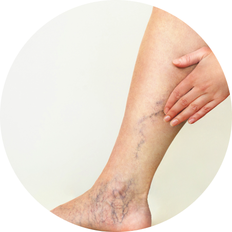 Varicose Veins