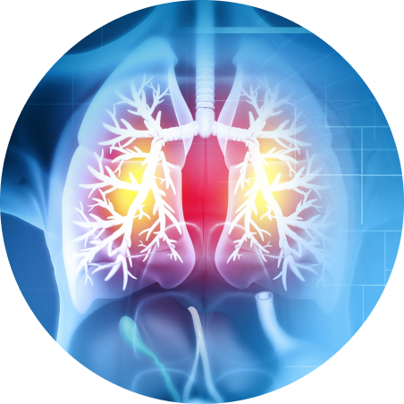 Interstitial Lung diseases